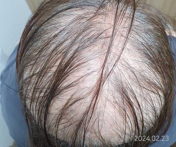 원형 탈모 (치료 2개월, 한약 2개월, 두피관리 7회)