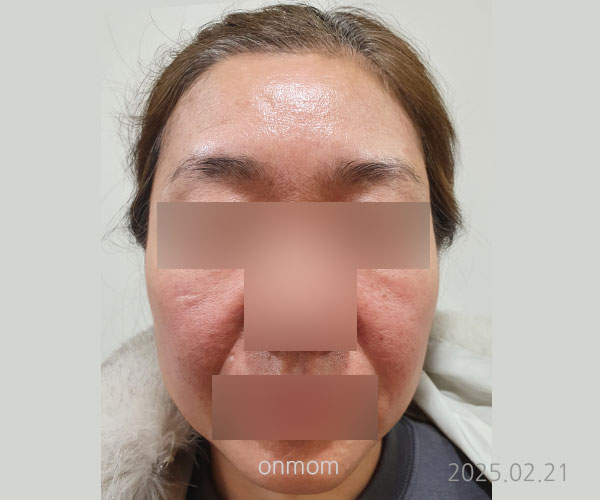 안면홍조 두드러기 - 한약(4개월 15일) + 돌뜸 + 침치료