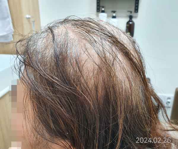 원형탈모 (치료 3개월, 한약 및 두피관리)