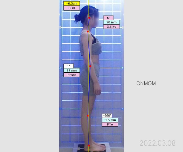 체형교정, 거북목, 골반교정, 어깨비대칭 (치료 7회)