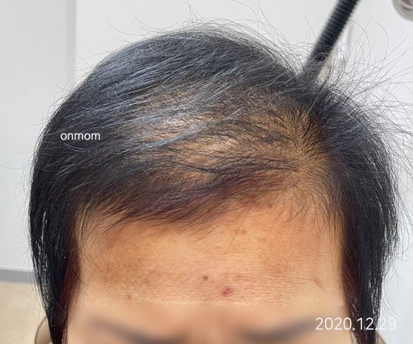 화상으로 인한 휴지기탈모 (치료 6개월, 한약 3개월+주 1회 탈모관리 6개월)