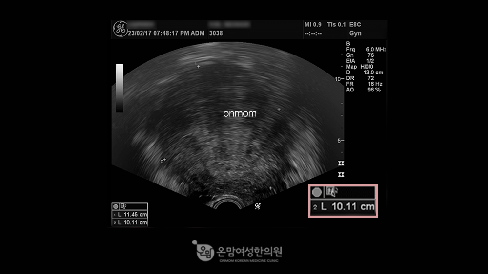 자궁선근증-한약, 침구치료, 좌훈치료 3개월(10.11cm->7.77cm)