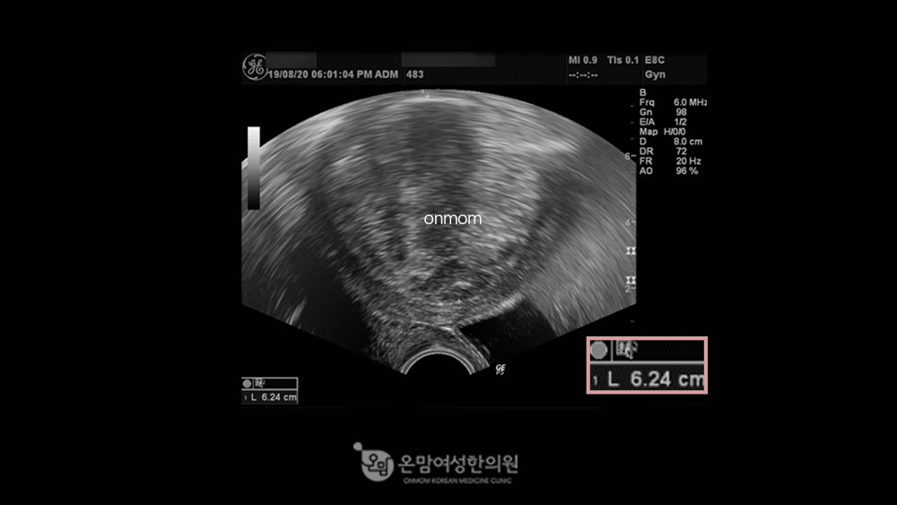 자궁근종치료 - 한약, 침구치료, 좌훈치료 3개월 (6.24cm->3.89cm)