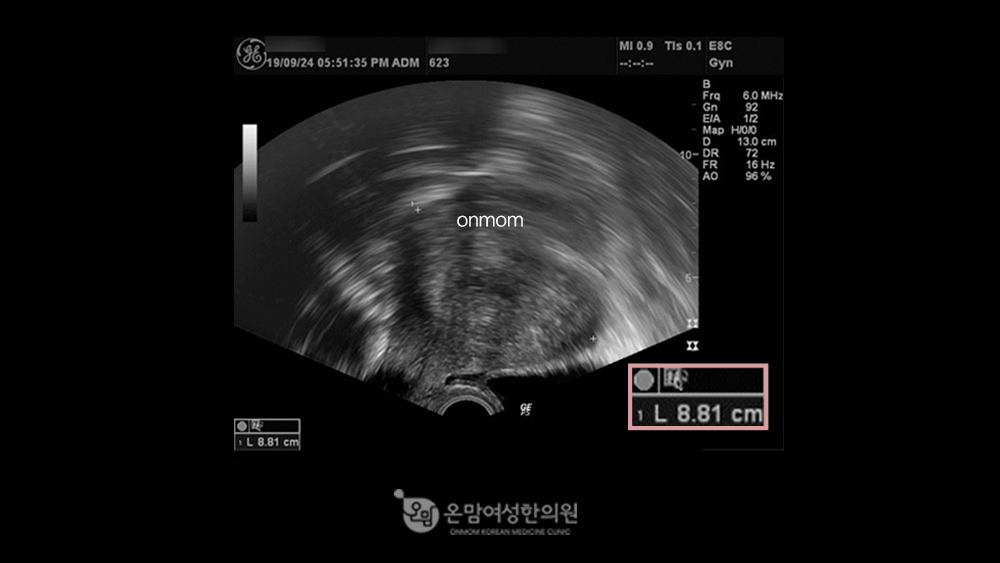 자궁선근증-한약,침구치료,좌훈치료 3개월(8.81cm->7.42cm)