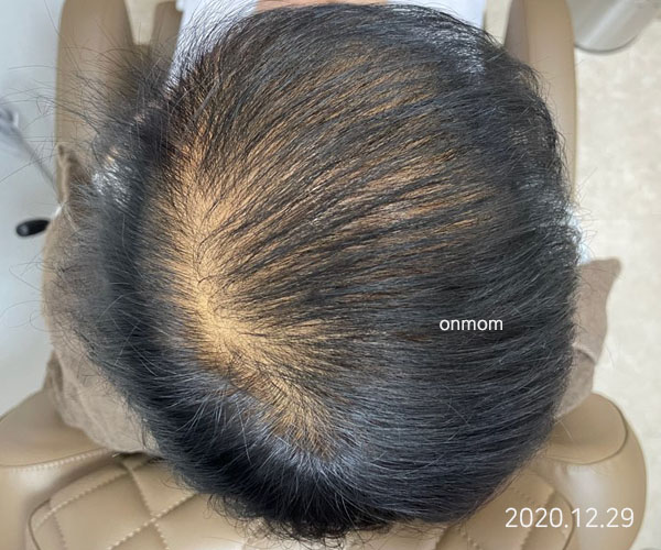 화상으로 인한 휴지기탈모 (치료 6개월, 한약 3개월+주 1회 탈모관리 6개월)