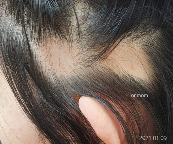 원형탈모(치료 1년2개월, 한약 1개월, 주1회 두피관리)