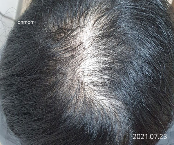 정수리탈모 (치료 6개월, 한약 6개월 + 주 1회 두피관리)