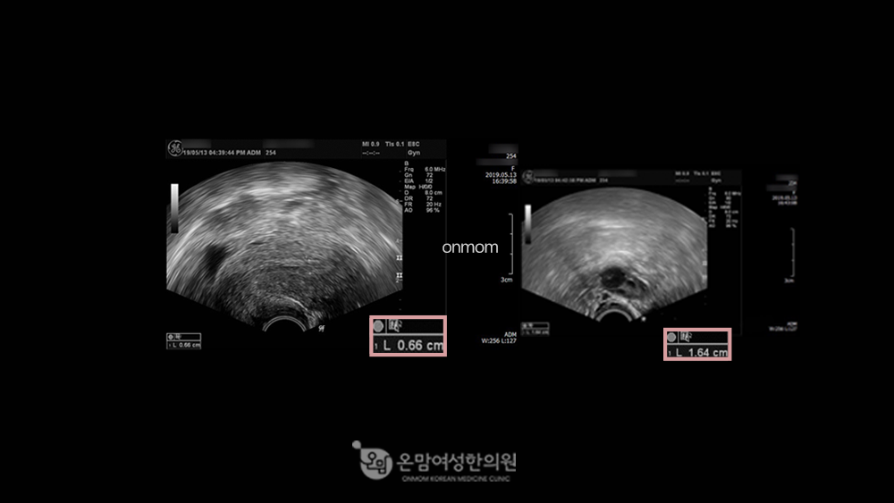 생리양과소/자궁내막얇음 -한약,침구치료,좌훈치료 3개월(0.66cm->1.15cm)